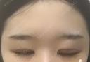 二重切開 / 目頭切開 / 眼瞼下垂（切開） / その他（目元） ブリスクリニック形成外科・美容外科・美容皮膚科 福岡 DAY 8 サムネイル用