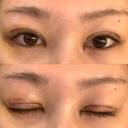 二重切開 / 目頭切開 / 眼瞼下垂（切開） / 脂肪吸引（顔） eクリニック 金沢本院 DAY 6 サムネイル用