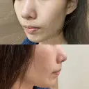 ダーマペン / 毛穴洗浄（ハイドラフェイシャルなど） / ミラノリピール La Clinique Shinjuku 【ラクリニック 新宿】 DAY 11 サムネイル用