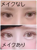 二重切開 / 目頭切開 / ヒアルロン酸注入（涙袋） FROM B整形外科 (旧バウム整形外科) DAY 11 サムネイル用