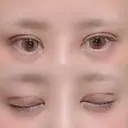 二重切開 / 目頭切開 / ヒアルロン酸注入（涙袋） FROM B整形外科 (旧バウム整形外科) DAY 11 サムネイル用