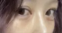 クマ治療 / 下まぶたたるみ取り / 下まぶたの脂肪取り APOLLO BEAUTY CLINIC DAY 3 サムネイル用