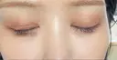 クマ治療 / 下まぶたたるみ取り / 下まぶたの脂肪取り APOLLO BEAUTY CLINIC DAY 12 サムネイル用
