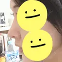 隆鼻術 / 鼻中隔延長（切開） / 小鼻縮小（切開） / 軟骨移植 / 鼻修正 / 鼻孔縁下降 FROM B整形外科 (旧バウム整形外科) DAY 35 サムネイル用