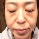 プラセンタ注射 / ピーリング（ニキビ・毛穴） / イオン導入 / シミ取りレーザー ナチュラルハーモニークリニック表参道 DAY 104 サムネイル用