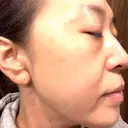 プラセンタ注射 / ピーリング（ニキビ・毛穴） / イオン導入 / シミ取りレーザー ナチュラルハーモニークリニック表参道 DAY 104 サムネイル用