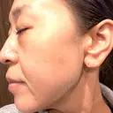 プラセンタ注射 / ピーリング（ニキビ・毛穴） / イオン導入 / シミ取りレーザー ナチュラルハーモニークリニック表参道 DAY 104 サムネイル用