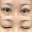 二重切開 / 目頭切開 / 眼瞼下垂（切開） / 脂肪吸引（顔） eクリニック 金沢本院 DAY 9 サムネイル用