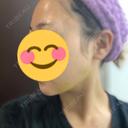 二重切開 / 目頭切開 / 眼瞼下垂（切開） / 脂肪吸引（顔） eクリニック 金沢本院 DAY 9 サムネイル用
