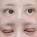 二重切開 / 目頭切開 / ヒアルロン酸注入（涙袋） FROM B整形外科 (旧バウム整形外科) DAY 12 サムネイル用