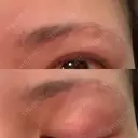 眉下切開 湘南美容クリニック 赤羽院 DAY 8 サムネイル用