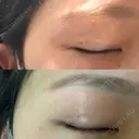 二重埋没 R.O.clinic DAY 381 サムネイル用