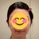アートメイク（唇） LEAGRANT CLINIC 中目黒 DAY 4 サムネイル用