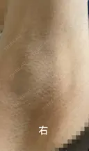 ワキ汗治療（ボトックス） Mare beauty clinic DAY 9 サムネイル用