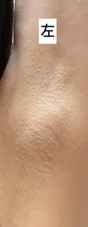 ワキ汗治療（ボトックス） Mare beauty clinic DAY 10 サムネイル用