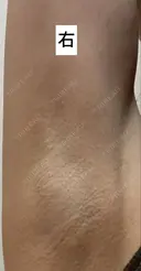 ワキ汗治療（ボトックス） Mare beauty clinic DAY 10 サムネイル用