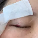 二重埋没 R.O.clinic DAY 382 サムネイル用