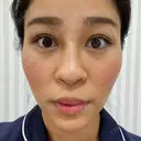 ヒアルロン酸注入（鼻） / ヒアルロン酸注入（あご） 東京ミッドクリニック DAY 6 サムネイル用