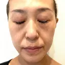 プラセンタ注射 / ピーリング（ニキビ・毛穴） / イオン導入 / シミ取りレーザー ナチュラルハーモニークリニック表参道 DAY 107 サムネイル用