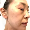 プラセンタ注射 / ピーリング（ニキビ・毛穴） / イオン導入 / シミ取りレーザー ナチュラルハーモニークリニック表参道 DAY 107 サムネイル用