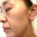 プラセンタ注射 / ピーリング（ニキビ・毛穴） / イオン導入 / シミ取りレーザー ナチュラルハーモニークリニック表参道 DAY 107 サムネイル用