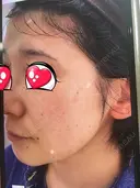 光治療（フォトフェイシャルなど） BMC CLINIC 南青山 DAY 47 サムネイル用