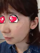 光治療（フォトフェイシャルなど） BMC CLINIC 南青山 DAY 49 サムネイル用