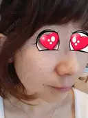 光治療（フォトフェイシャルなど） BMC CLINIC 南青山 AFTER サムネイル用