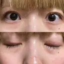 二重切開 松下皮フ形成外科 DAY 83 サムネイル用