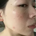 光治療（フォトフェイシャルなど） LETICIA CLINIC（レティシア クリニック） DAY 1 サムネイル用