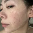 光治療（フォトフェイシャルなど） LETICIA CLINIC（レティシア クリニック） DAY 1 サムネイル用