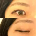 二重埋没 R.O.clinic DAY 386 サムネイル用