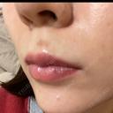 アートメイク（唇） LEAGRANT CLINIC 中目黒 DAY 4 サムネイル用