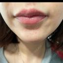 アートメイク（唇） LEAGRANT CLINIC 中目黒 DAY 5 サムネイル用