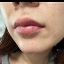アートメイク（唇） LEAGRANT CLINIC 中目黒 DAY 5 サムネイル用