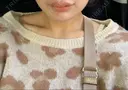 ヒアルロン酸注入（あご） レナトゥスクリニック 東京田町院 DAY 17 サムネイル用