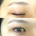 二重埋没 R.O.clinic DAY 391 サムネイル用