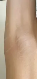 ワキ汗治療（ボトックス） Mare beauty clinic AFTER サムネイル用