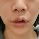 人中短縮 / その他（口元） eクリニック 金沢本院 DAY 2 サムネイル用