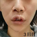 人中短縮 / その他（口元） eクリニック 金沢本院 DAY 2 サムネイル用