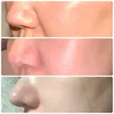 鼻尖形成（切開） / その他（鼻） / 軟骨移植 / 鼻修正 eクリニック 金沢本院 AFTER サムネイル用