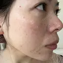 光治療（フォトフェイシャルなど） LETICIA CLINIC（レティシア クリニック） AFTER サムネイル用