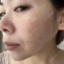 光治療（フォトフェイシャルなど） LETICIA CLINIC（レティシア クリニック） DAY 9 サムネイル用