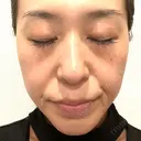 プラセンタ注射 / ピーリング（ニキビ・毛穴） / イオン導入 / シミ取りレーザー ナチュラルハーモニークリニック表参道 AFTER サムネイル用