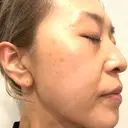 プラセンタ注射 / ピーリング（ニキビ・毛穴） / イオン導入 / シミ取りレーザー ナチュラルハーモニークリニック表参道 DAY 118 サムネイル用