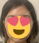 脂肪吸引（顔） パールスキンクリニック天神 DAY 9 サムネイル用