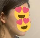 脂肪吸引（顔） パールスキンクリニック天神 DAY 9 サムネイル用