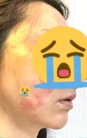 糸リフト / 水光注射（ハリ・美肌） / ヒアルロン酸注入（あご） / ハイフ（顔） 品川スキンクリニック表参道院 DAY 7 サムネイル用