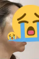 糸リフト / 水光注射（ハリ・美肌） / ヒアルロン酸注入（あご） / ハイフ（顔） 品川スキンクリニック表参道院 DAY 8 サムネイル用