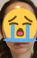 糸リフト / 水光注射（ハリ・美肌） / ヒアルロン酸注入（あご） / ハイフ（顔） 品川スキンクリニック表参道院 DAY 9 サムネイル用